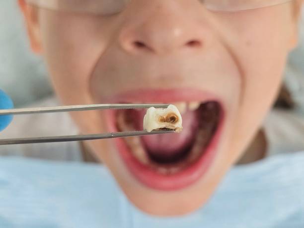 Best Emergency Tooth Extraction in Sale Creek, TN
